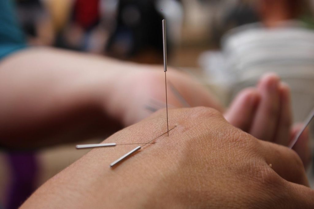 Acupuncturist in Gorinchem voert behandeling uit met dunne naalden voor holistische gezondheid en welzijn
